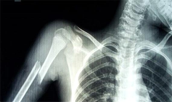 عوارض پرتوگیری‌های پزشکی غیرضرور به بهانه سالروز «کشف اشعه ایکس»