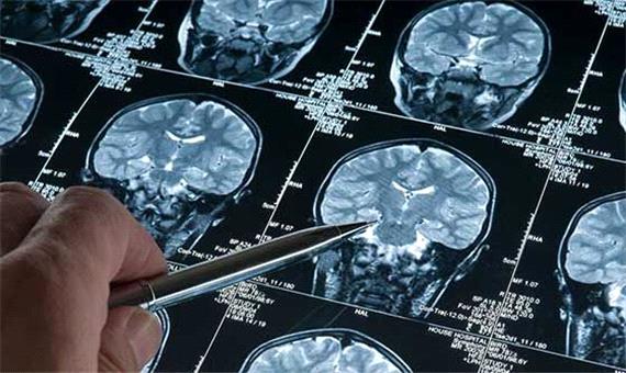 تشخیص دقیق تومور مغزی با آزمایش ادرار