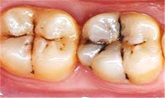 کشف روشی جدید برای درمان پوسیدگی دندان