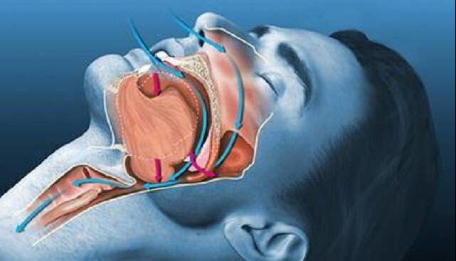 موفقیت ۹۳ درصدی درمان جدید آپنه خواب