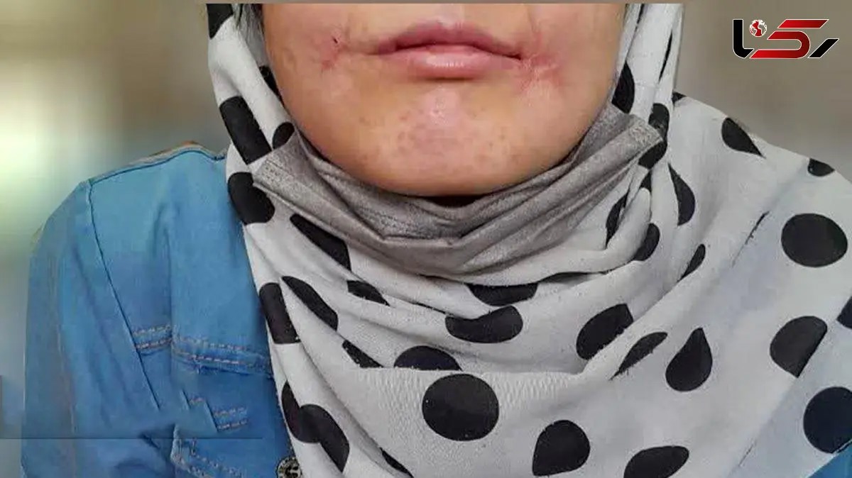 ماجرای مردی که لب‌های همسر ۱۸ ساله‌اش را دوخت!