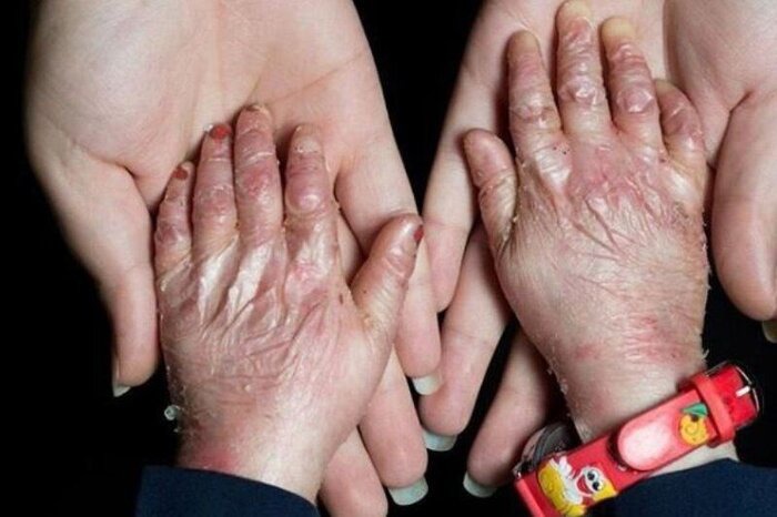 ماجرای فوت ۱۵ بیمار پروانه‌ای ایرانی به‌خاطر کارشکنی شرکت سوئدی